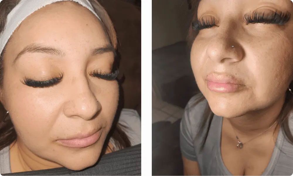 lip-filler-results