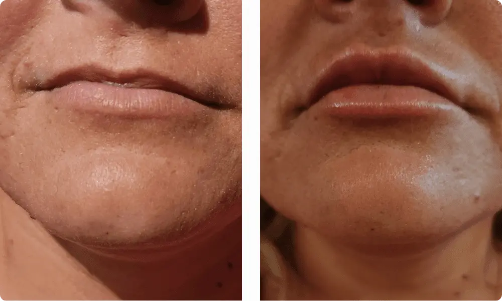 lip-filler-before-and-after