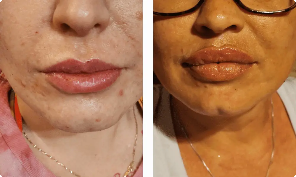 lip-filler-previous-work