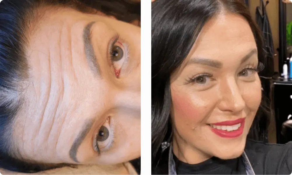 forehead-botox-results