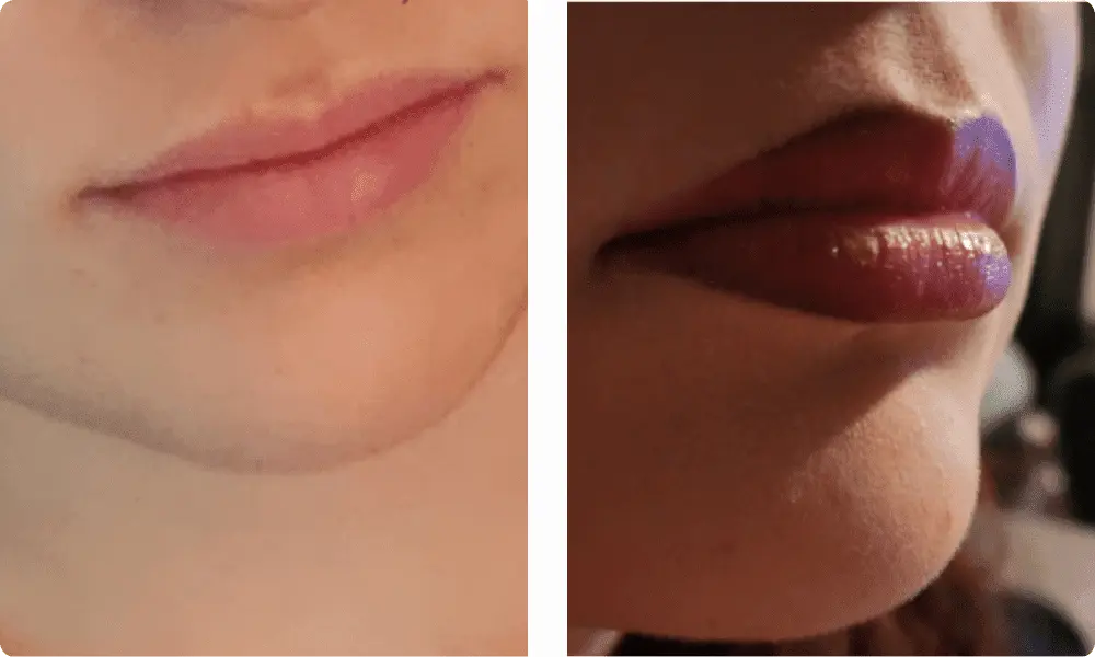 lip-flip-before-and-after
