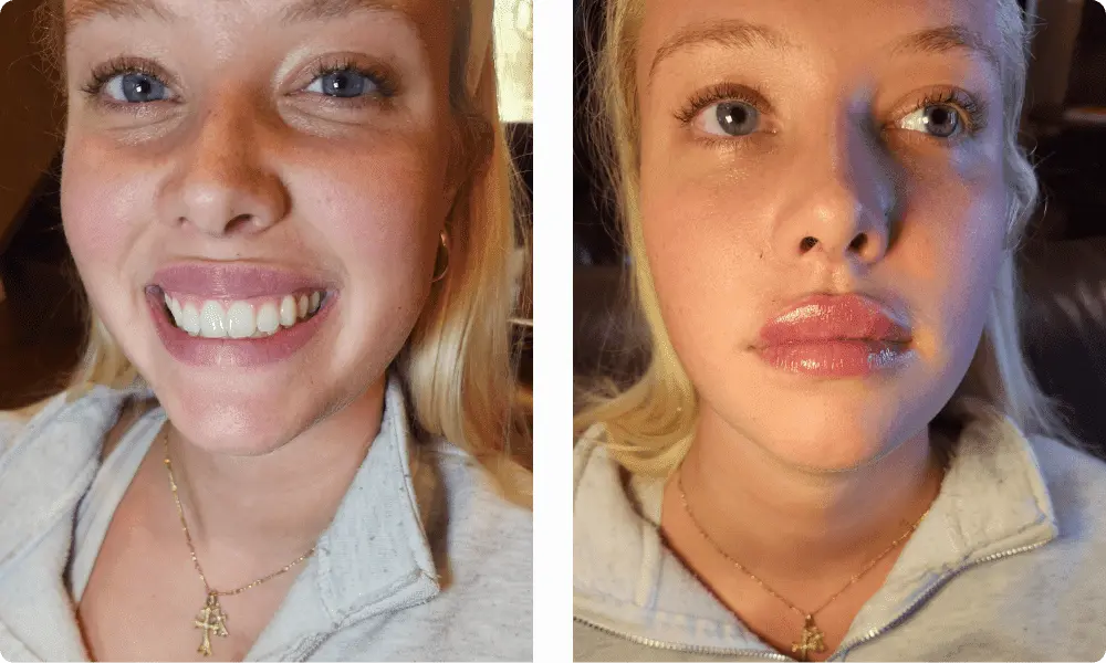lip-filler-lip-flip-services